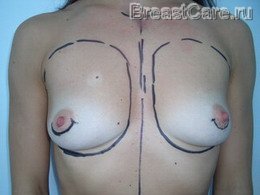 Увеличение груди - каплевидные импланты - случай №1 - ДО операции