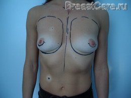 Увеличение груди - каплевидные импланты - случай №1 - ДО операции