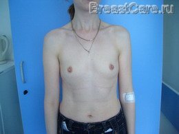 Увеличение груди - каплевидные импланты – пример №3 - фото ДО операции