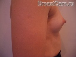 Увеличение груди - каплевидные импланты – пример №5 - фото ДО операции