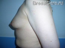 Увеличение размера груди - фото ДО операции