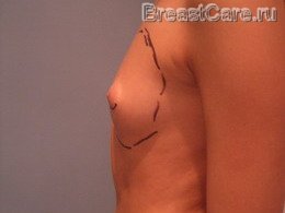 Увеличение груди – каплевидные имплантаты - фото ДО операции