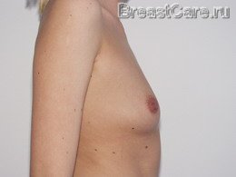 Увеличение груди – каплевидные импланты - фото ДО операции